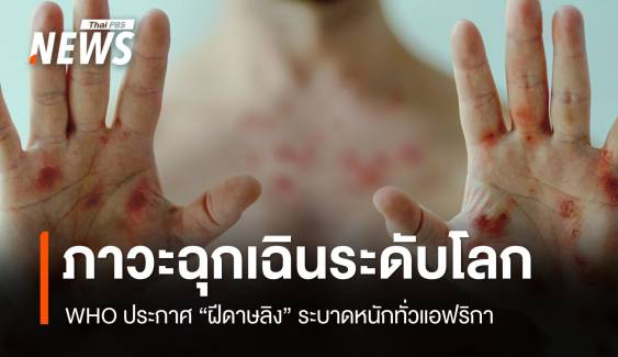 WHO ประกาศ "ฝีดาษลิง" ภาวะฉุกเฉินด้านสาธารณสุขระดับโลก