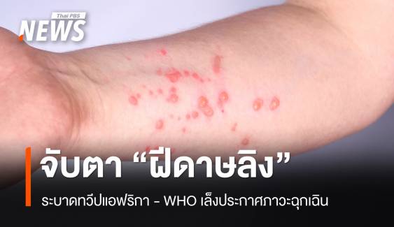 "ฝีดาษลิง" ระบาดทวีปแอฟริกา WHO เล็งประกาศภาวะฉุกเฉิน