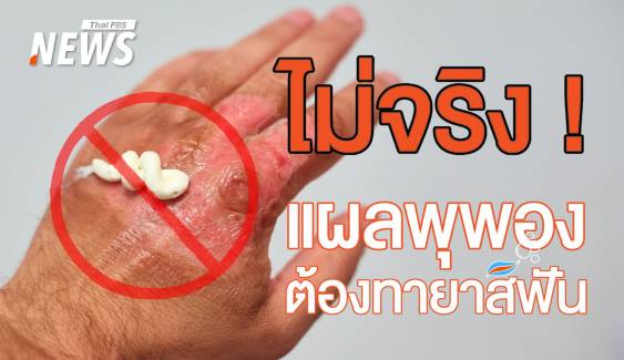 ห้าม! ทายาสีฟันในแผลโดนเตารีด ความเชื่อผิด ๆ ที่อันตราย