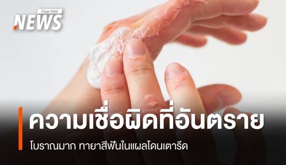 ห้าม! ทายาสีฟันในแผลโดนเตารีด ความเชื่อผิด ๆ ที่อันตราย