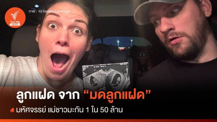 ลูกแฝดจาก "มดลูกแฝด" มหัศจรรย์ แม่มะกัน 1 ใน 50 ล้าน