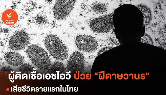 ผู้ติดเชื้อเอชไอวีป่วย "ฝีดาษวานร" เสียชีวิตคนแรกในไทย