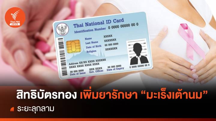 สิทธิบัตรทอง เพิ่มยารักษา"มะเร็งเต้านม"ระยะลุกลาม