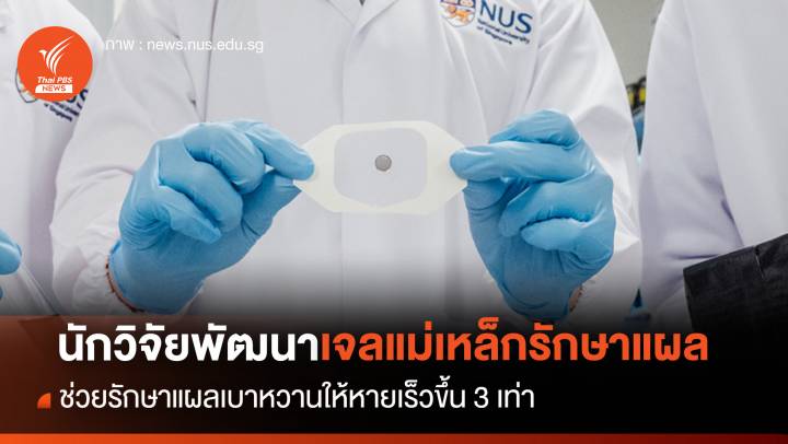 นักวิจัยพัฒนา "เจลแม่เหล็ก" ช่วยรักษาแผลเบาหวานให้หายเร็วขึ้น 3 เท่า