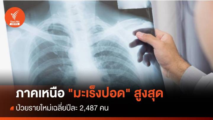 ภาคเหนือ ป่วย "มะเร็งปอด" สูงสุด เฉลี่ยปีละ 2,487 คน