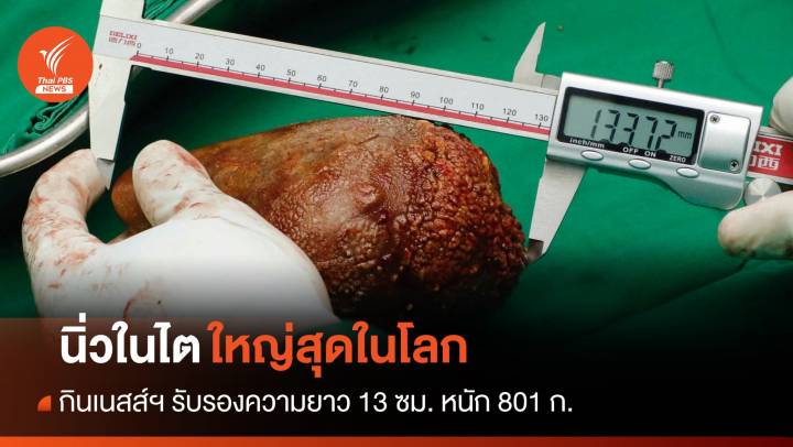 ศรีลังกาผ่าตัด "นิ่วในไต" ใหญ่สุดในโลก ยาว 13.37 ซม.