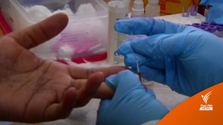ผู้หญิงคนแรกในสหรัฐฯ หายจาก HIV หลังปลูกถ่ายเซลล์ต้นกำเนิด
