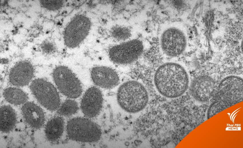 พบข้อมูล "ฝีดาษลิง 2022" เปลี่ยนแปลงเร็วกว่าไวรัสปกติ 10 เท่า