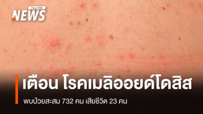 เตือนเฝ้าระวัง "โรคเมลิออยด์โดสิส" พบป่วยสะสม 732 คน เสียชีวิต 23 คน