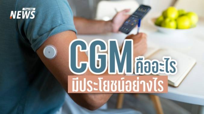 CGM คืออะไร? รู้จักเครื่องวัดระดับน้ำตาลต่อเนื่อง ใครควรใช้ และมีประโยชน์อย่างไร