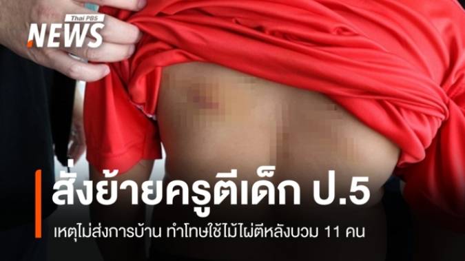 สพป.กาฬสินธุ์ สั่งย้ายครูตีเด็ก ป.5 หลังช้ำบวม 11 คน เหตุไม่ส่งการบ้าน