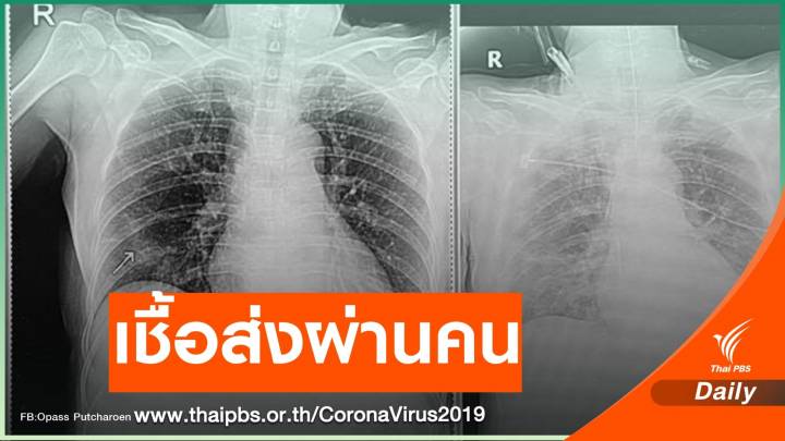 หมอเตือนตัวอย่างจริงไม่กักตัวส่งเชื้อ COVID-19 ติดแม่