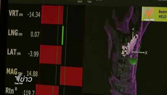 สธ.เตรียมประสานขอรายชื่อผู้เข้ารับฝังแร่ไอโอดีนจาก รพ.ในจีน